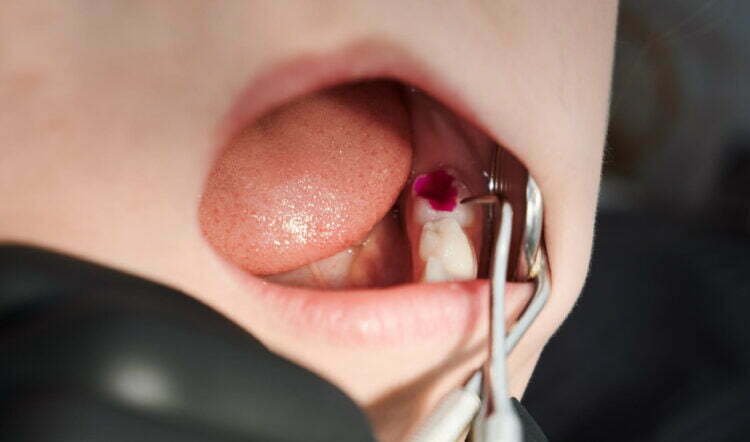 caries dentaires